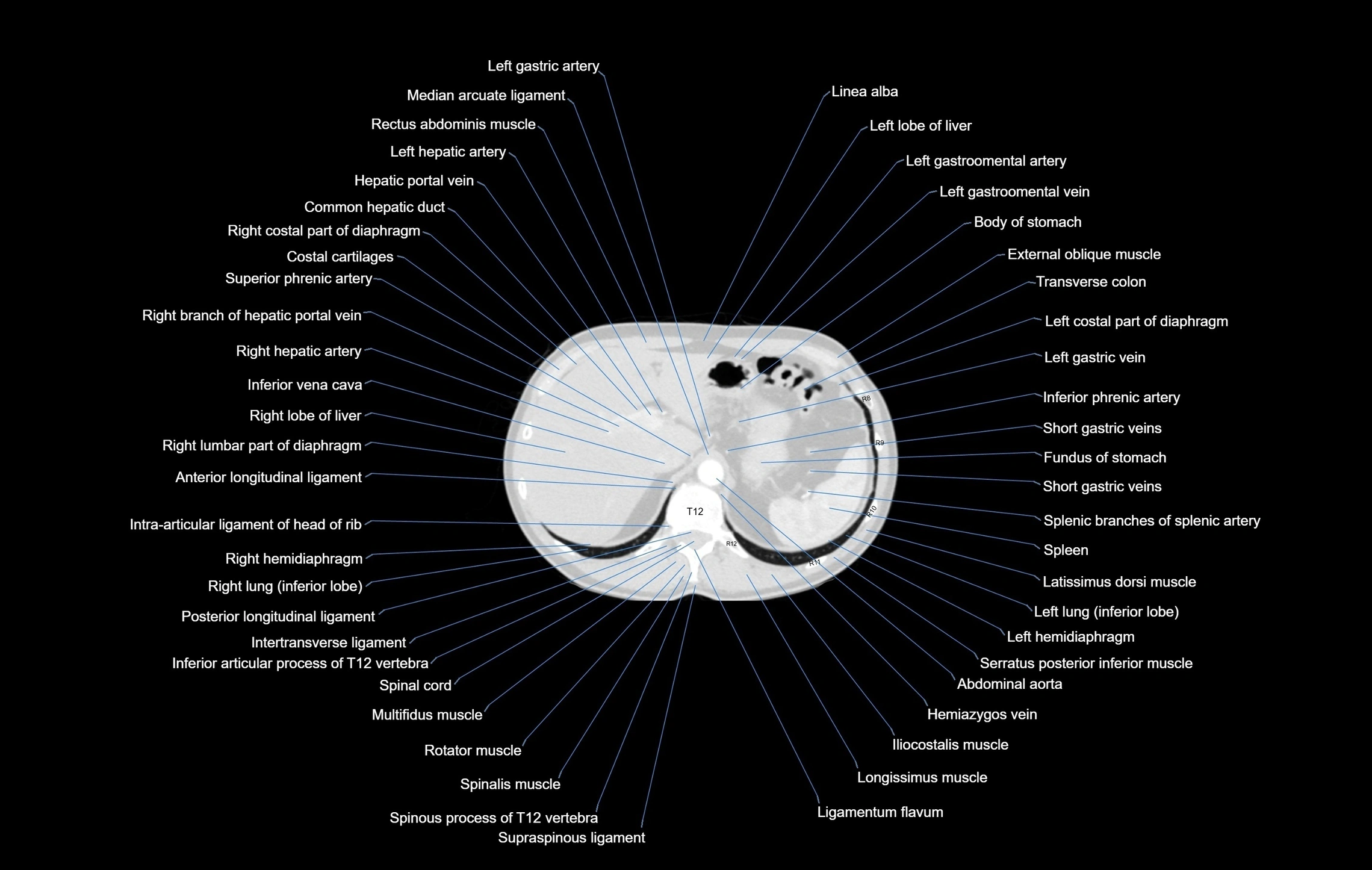 CT chest (thorax) labelled axial cross sectional anatomy radiology image-00115.webp